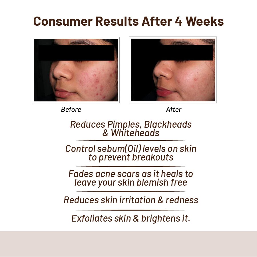 Acne & Oil Control Serum : Best Face Serum for Oily Acne-Prone Skin